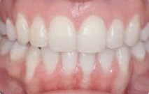 Clare after invisalign