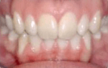 Clare before invisalign