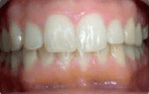 Davide after invisalign