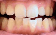 Davide before invisalign