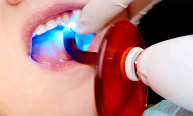 Copley Dental - Dental Information - Dental Sealants