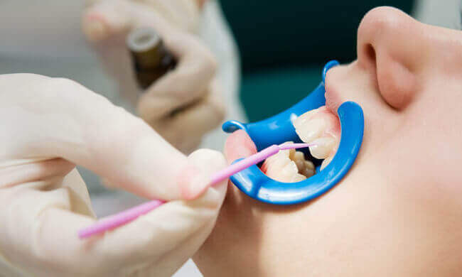 Copley Dental - Dental Information - Fluoride