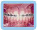 Front Gap - Orthodontic