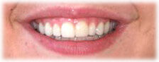 CASE # 2: Cosmetic Dentistry - Lumineers (after)