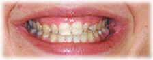 CASE # 2: Cosmetic Dentistry - Lumineers (before)