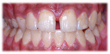 CASE # 4: General and Cosmetic Dentistry - Cleaning - Teeth Whitening (after)