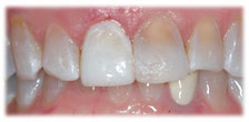 CASE # 5: Emergency Treatment - Fractured or Broken Tooth (after)