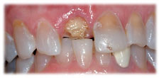 CASE # 5: Emergency Treatment - Fractured or Broken Tooth (before)