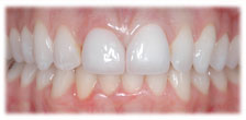 CASE # 6: Cosmetic Dentistry - All-Porcelain Crowns (after)