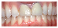 CASE # 6: Cosmetic Dentistry - All-Porcelain Crowns (before)