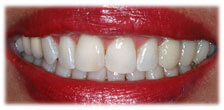 CASE #8: Cosmetic Dentistry - Teeth Whitening (after)