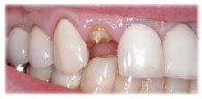 CASE #9: Emergency Treatment - Fractured Tooth (before)