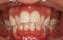 Khadija before Invisalign