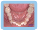 Lower Crowding - Orthodontic