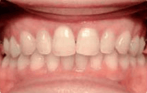 Marie after invisalign