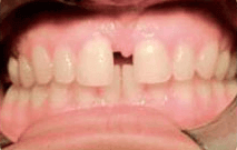 Marie before invisalign