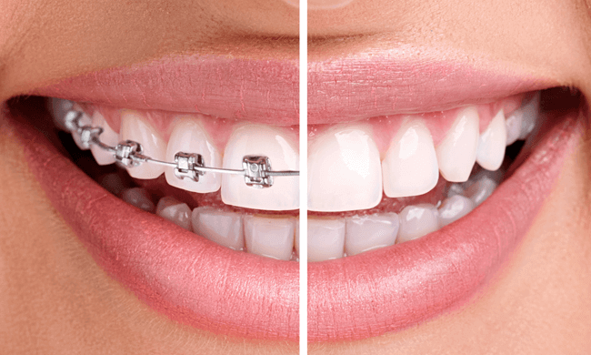 Orthodontics Dentist In Natick Braces