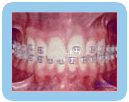 Placement of Brackets - Orthodontic