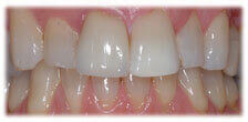Veneers - Stained Teeth before